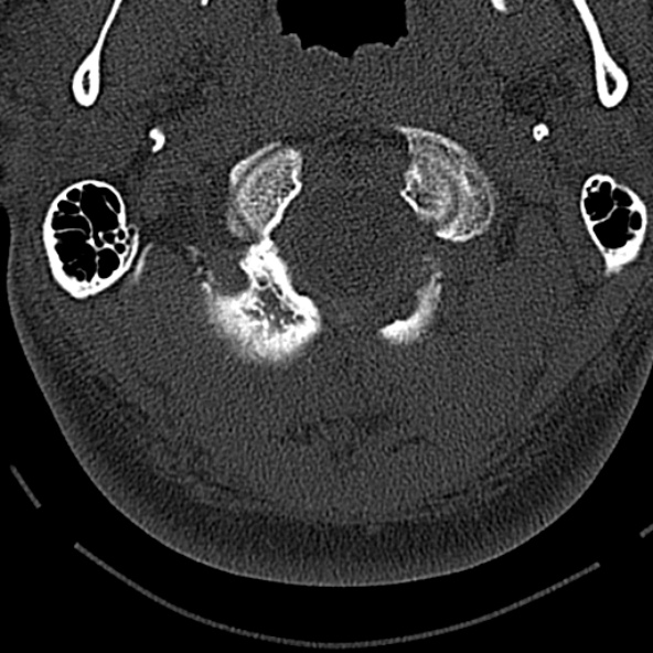 Normal CT of the cervical spine (Radiopaedia 53322-59305 Axial bone window 46).jpg