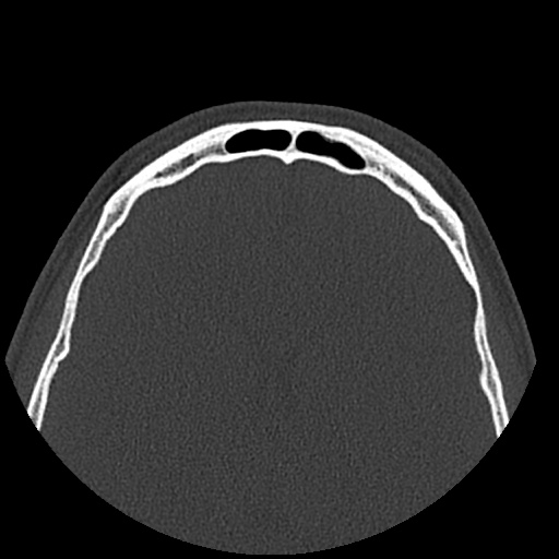 Normal CT paranasal sinuses (Radiopaedia 42286-45390 Axial bone window 16).jpg
