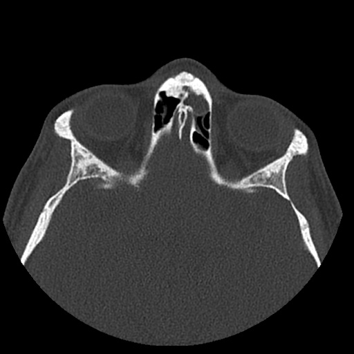 Normal CT paranasal sinuses (Radiopaedia 42286-45390 Axial bone window 37).jpg