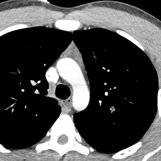 File:Normal CT pulmonary veins (pre RF ablation) (Radiopaedia 41748-44702 A 11).png