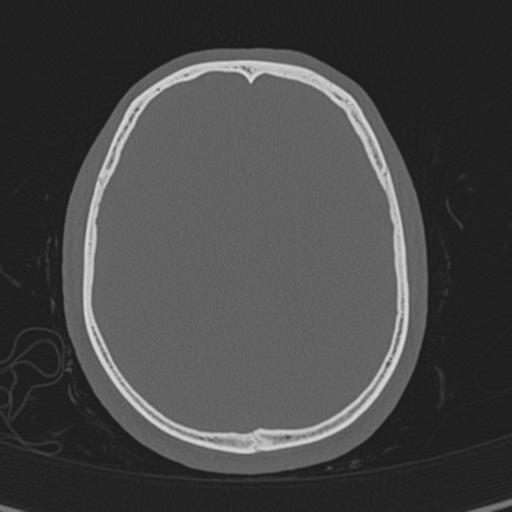 Normal CT skull (Radiopaedia 40798-43459 A 109).png