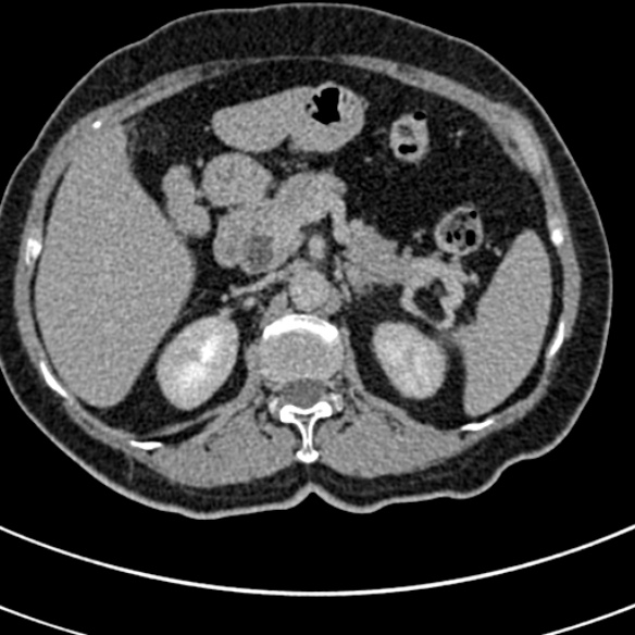 File:Normal CT split bolus study of the renal tract (Radiopaedia 48631-53634 Axial split bolus 38).jpg