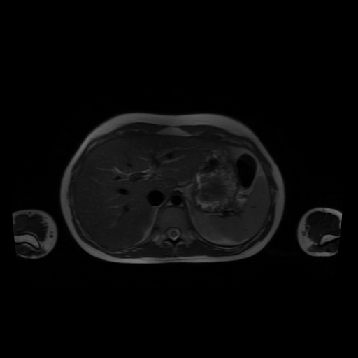File:Normal MRI abdomen in pregnancy (Radiopaedia 88001-104541 Axial T2 11).jpg