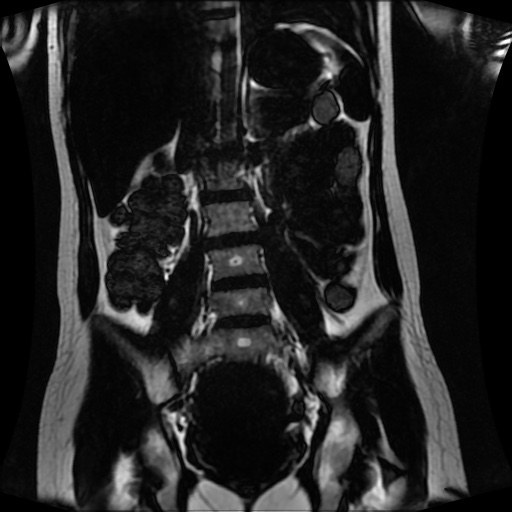 Normal MRI abdomen in pregnancy (Radiopaedia 88001-104541 N 84).jpg