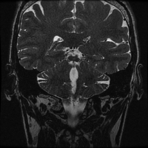 Normal MRI petrous (Radiopaedia 91317-108949 Coronal T2 79).jpg