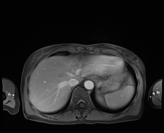 Normal adrenal glands MRI (Radiopaedia 82017-96004 M 14).jpg