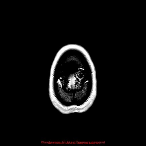 Normal adult brain MRI (non-enhanced and contrast-enhanced) (Radiopaedia 75262-86379 Axial T1 C+ 172).jpg