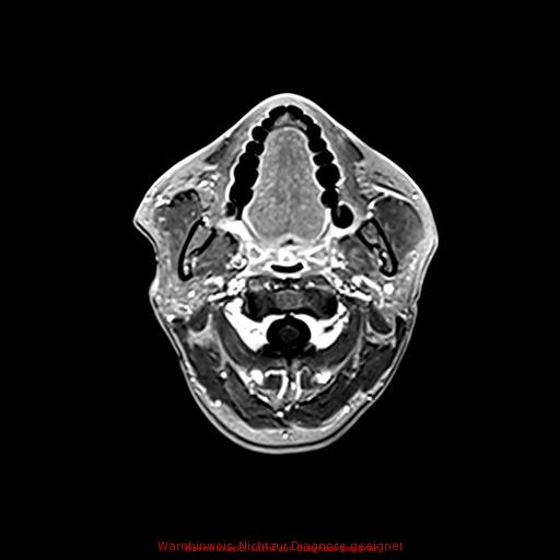 Normal adult brain MRI (non-enhanced and contrast-enhanced) (Radiopaedia 75262-86379 Axial T1 C+ 22).jpg