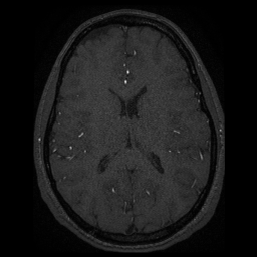 Normal brain MRA (Radiopaedia 41046-43793 Axial MRA 6).png