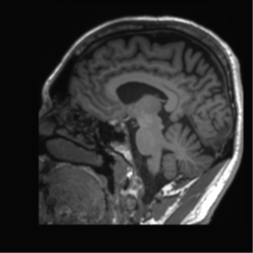 Normal brain MRI (non-focal epilepsy protocol) (Radiopaedia 53917-60040 Sagittal T1 30).png