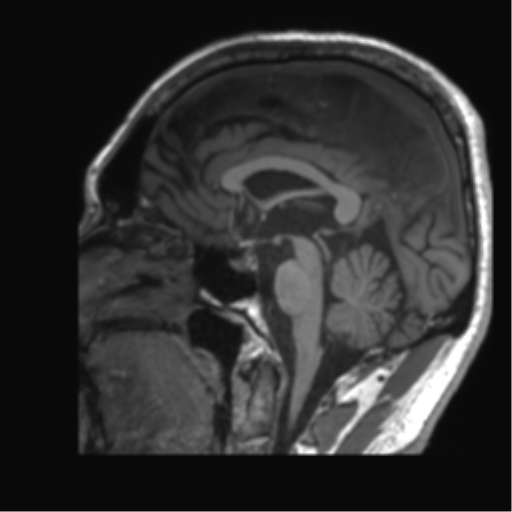 Normal brain MRI (non-focal epilepsy protocol) (Radiopaedia 53917-60040 Sagittal T1 33).png