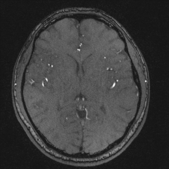 Normal brain MRI including MRA (Radiopaedia 48748-53763 Axial MRA 116).jpg