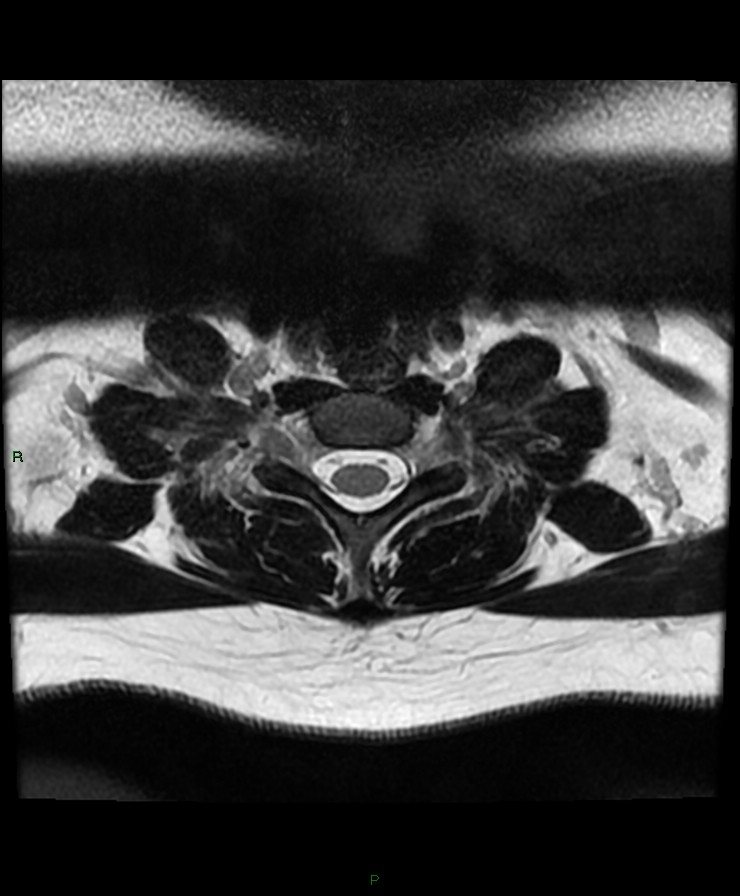 Normal cervical spine MRI (Radiopaedia 80146-93454 Axial T2 85).jpg
