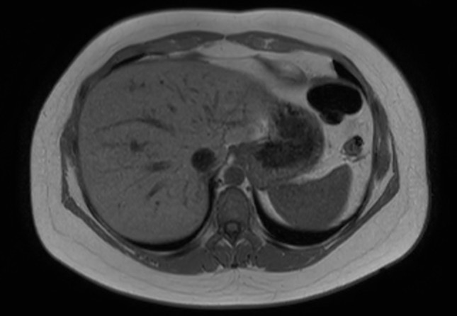 File:Normal liver MRI with Gadolinium (Radiopaedia 58913-66163 Axial T1 in-phase 25).jpg