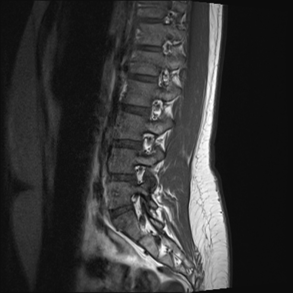 File:Normal lumbar spine MRI- 3 T (Radiopaedia 53280-59250 Sagittal T1 8).jpg