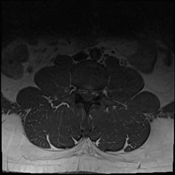 File:Normal lumbar spine MRI (Radiopaedia 47857-52609 Axial T1 4).jpg