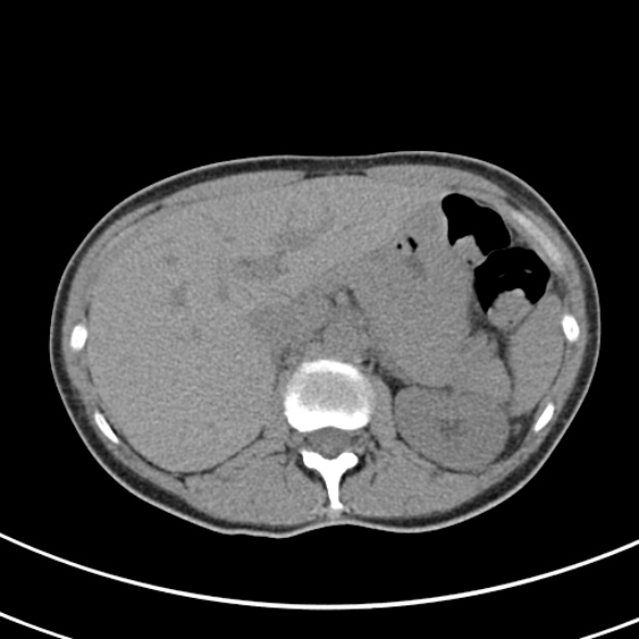 File:Normal multiphase CT liver (Radiopaedia 38026-39996 Axial non-contrast 19).jpg