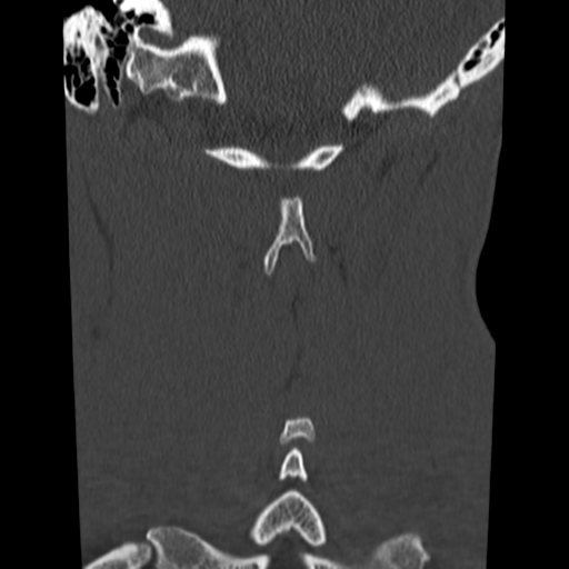 File:Normal trauma cervical spine (Radiopaedia 41017-43760 Coronal bone window 35).png
