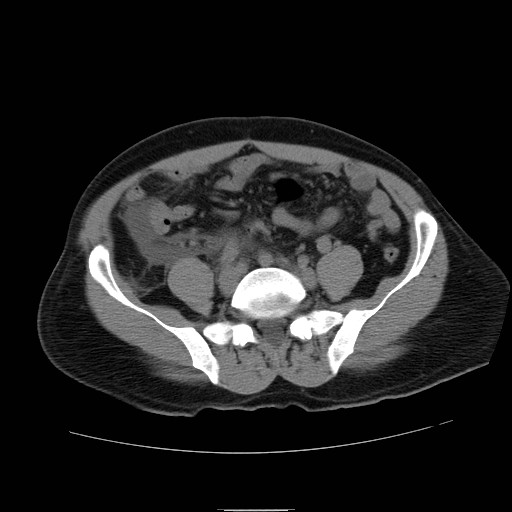 File:Obstructed kidney with perinephric urinoma (Radiopaedia 26889-27066 Axial non-contrast 45).jpg