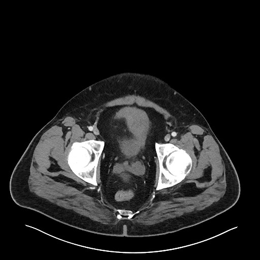 Obstructing sigmoid adenocarcinoma (Radiopaedia 58465-65619 A 150).jpg