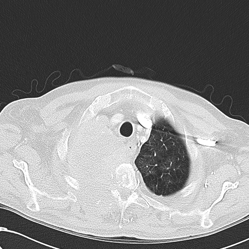 File:Obstructive superior vena cava tumor thrombus (Radiopaedia 28046-28306 Axial lung window 9).jpg