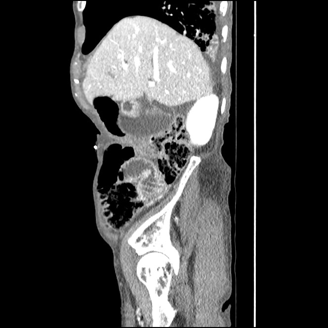 Obturator hernia causing small bowel obstruction (Radiopaedia 65522-74612 C 77).jpg