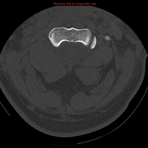 File:Occipital condyle fracture (Radiopaedia 18366-18208 Axial bone window 23).jpg