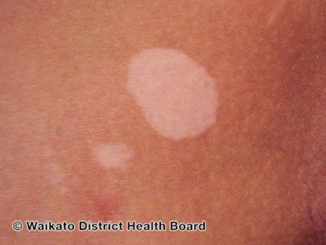 File:Vitiligo (DermNet NZ colour-w-vitiligo-09).jpg