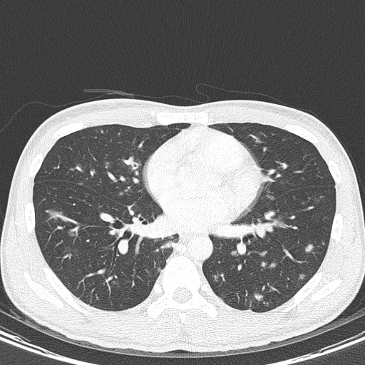AIDS-related Kaposi sarcoma (Radiopaedia 85247-100811 Axial lung window 99).jpg