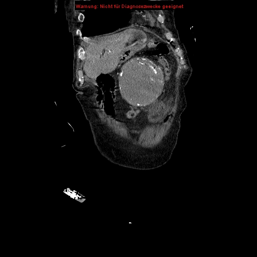 Abdominal aortic aneurysm- extremely large, ruptured (Radiopaedia 19882-19921 Coronal C+ arterial phase 18).jpg