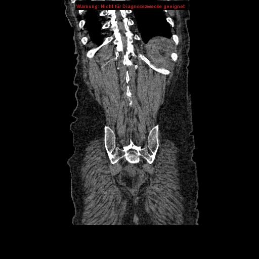 Abdominal aortic aneurysm- extremely large, ruptured (Radiopaedia 19882-19921 Coronal C+ arterial phase 93).jpg