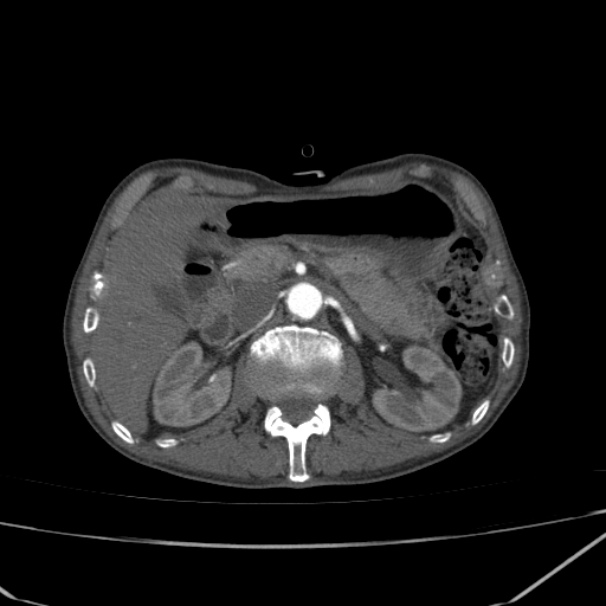 Abdominal aortic aneurysm (Radiopaedia 23703-23856 Axial C+ arterial phase 23).jpg