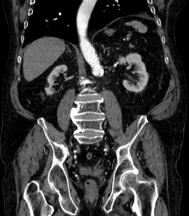 Abdominal aortic aneurysm (Radiopaedia 25855-26001 Coronal C+ arterial phase 46).jpg