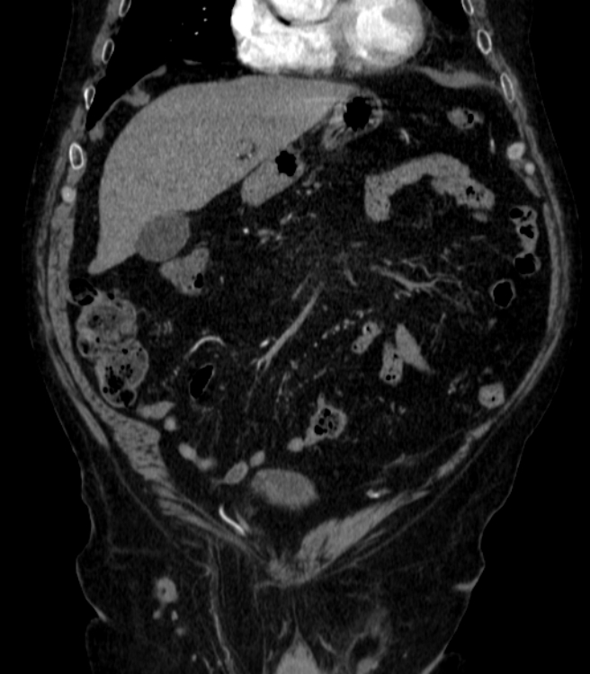 Abdominal aortic aneurysm (Radiopaedia 25855-26001 Coronal C+ arterial phase 6).jpg