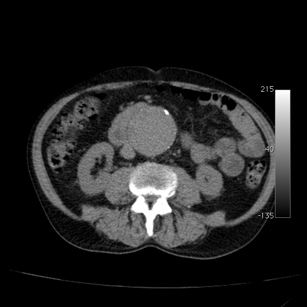Abdominal aortic aneurysm (Radiopaedia 29248-29660 Axial non-contrast 30).jpg