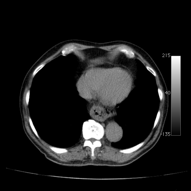 Abdominal aortic aneurysm (Radiopaedia 29248-29660 Axial non-contrast 6).jpg