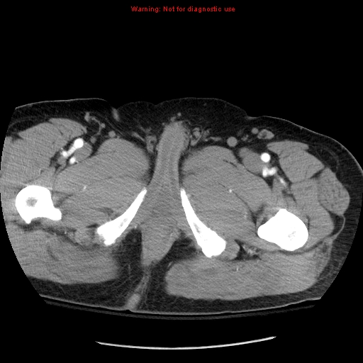Abdominal aortic aneurysm (Radiopaedia 8190-9038 Axial C+ arterial phase 92).jpg