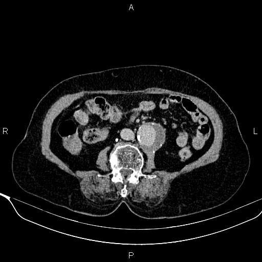 File:Abdominal aortic aneurysm (Radiopaedia 85063-100606 Axial C+ delayed 62).jpg