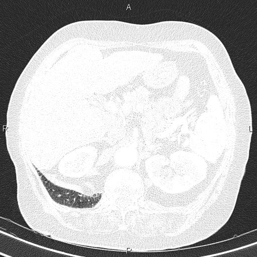Abdominal aortic aneurysm (Radiopaedia 85063-100606 Axial lung window 64).jpg