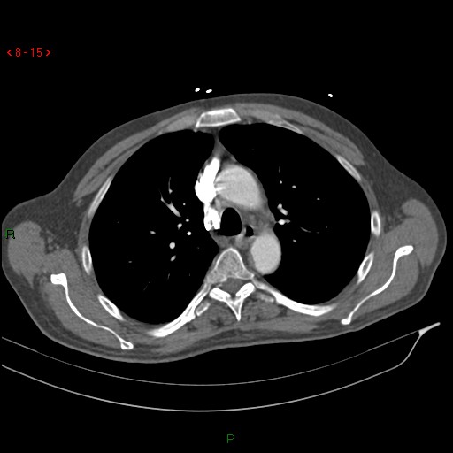 Abdominal aortic aneurysm rupture with aortocaval fistula (Radiopaedia 14897-14841 Axial C+ arterial phase 15).jpg