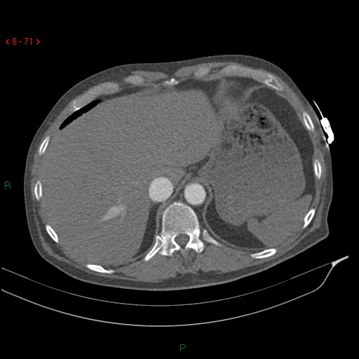 Abdominal aortic aneurysm rupture with aortocaval fistula (Radiopaedia 14897-14841 Axial C+ arterial phase 71).jpg