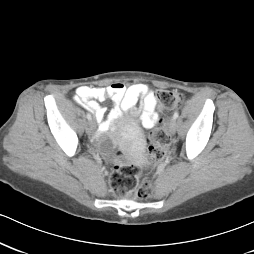 Abdominal desmoid tumor (Radiopaedia 41007-43740 Axial C+ portal venous phase 61).png