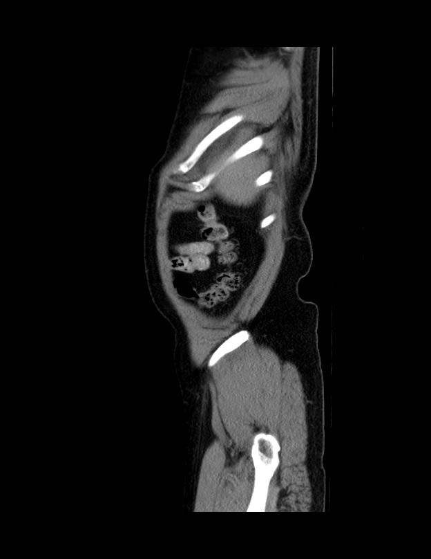 Abdominal lymphoma - with sandwich sign (Radiopaedia 53486-59492 Sagittal C+ portal venous phase 3).jpg