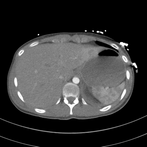 File:Abdominal multi-trauma - devascularised kidney and liver, spleen and pancreatic lacerations (Radiopaedia 34984-36486 Axial C+ arterial phase 78).png