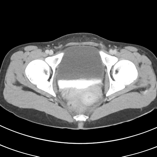 File:Abdominal multi-trauma - devascularised kidney and liver, spleen and pancreatic lacerations (Radiopaedia 34984-36486 Axial C+ delayed 77).png