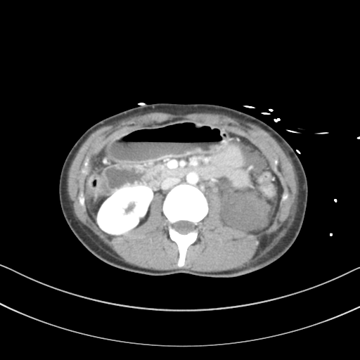 Abdominal multi-trauma - devascularised kidney and liver, spleen and pancreatic lacerations (Radiopaedia 34984-36486 Axial C+ portal venous phase 36).png