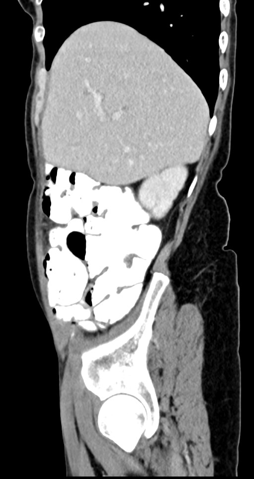 Abdominal wall and retroperitoneal tuberculosis (Radiopaedia 88137-104729 Sagittal C+ portal venous phase 117).jpg