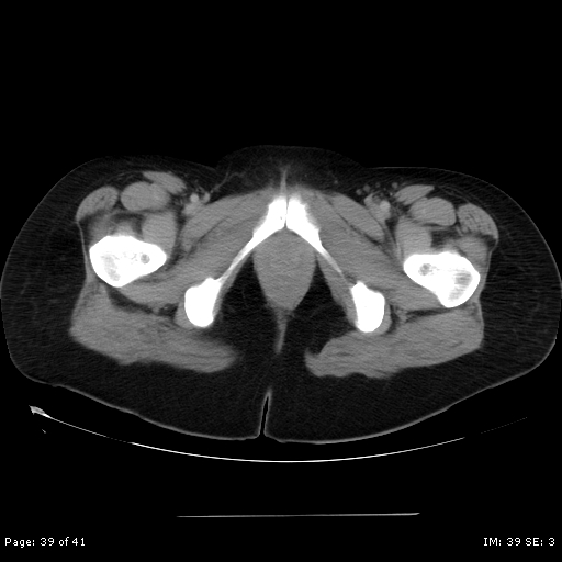 File:Abdominal wall endometriosis (Radiopaedia 25723-25885 Axial C+ portal venous phase 39).jpg