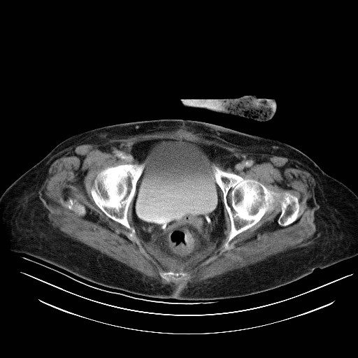 File:Abdominal wall recurrence after colorectal resection for cancer (Radiopaedia 23444-23523 Axial C+ portal venous phase 37).jpg