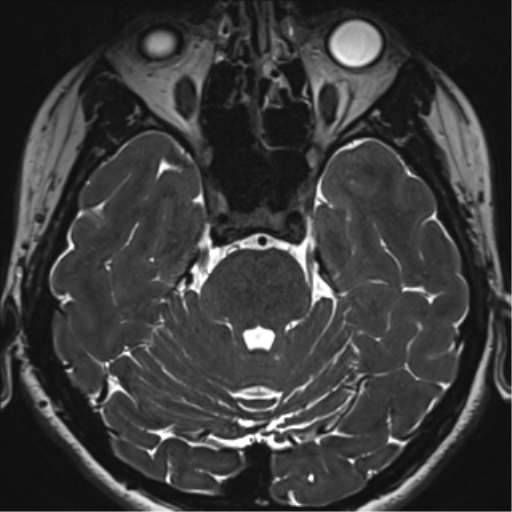 Abducens nerve palsy (Radiopaedia 51069-56648 Axial T2 fat sat 40).png